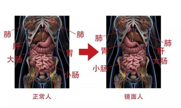 南宁一女子五脏六腑全部反着长，医生：罕见的先天性畸形，发病率约为百万分之一